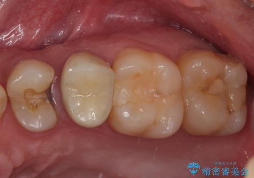 左上に違和感がある セラミックインレー修復の症例 治療前