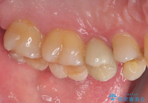 左上に違和感がある セラミックインレー修復の治療前
