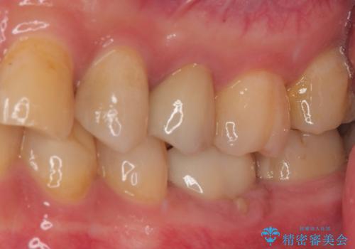 左上に違和感がある セラミックインレー修復の治療前