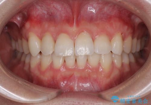 捻転の強い前歯 ワイヤー装置での非抜歯矯正の症例 治療後