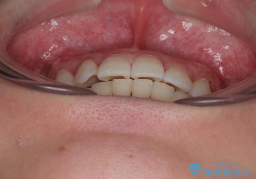 捻転の強い前歯 ワイヤー装置での非抜歯矯正の治療後