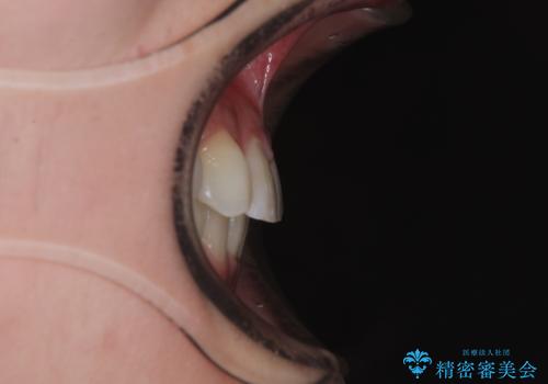 捻転の強い前歯 ワイヤー装置での非抜歯矯正の治療後