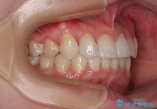 捻転の強い前歯 ワイヤー装置での非抜歯矯正の治療後