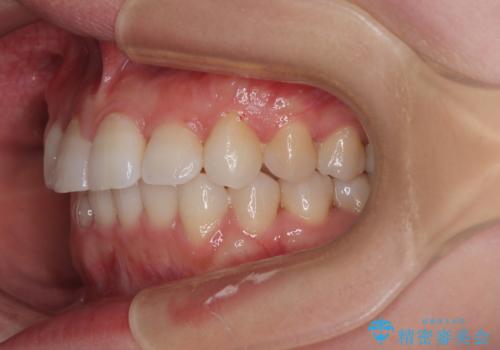 捻転の強い前歯 ワイヤー装置での非抜歯矯正の治療後