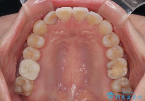 捻転の強い前歯 ワイヤー装置での非抜歯矯正の治療後