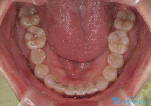 捻転の強い前歯 ワイヤー装置での非抜歯矯正の治療後