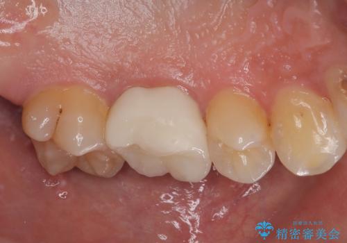 銀歯を外したい オールセラミッククラウンの治療後
