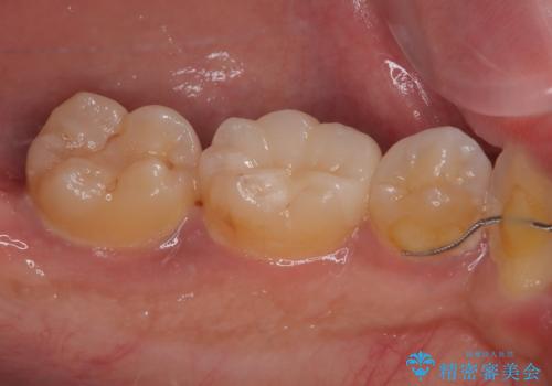 セラミックに取り替えたい セラミックインレー修復の治療後