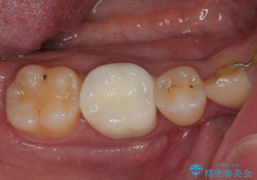 銀歯をセラミックにしたい オールセラミッククラウンの症例 治療後