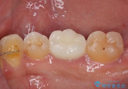銀歯をセラミックにしたい オールセラミッククラウンの治療後