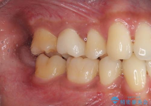 銀歯をセラミックにしたい オールセラミッククラウンの治療後
