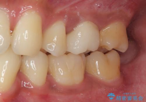 銀歯を外したい オールセラミッククラウンの治療後