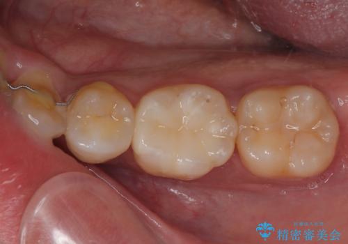 セラミックに取り替えたい セラミックインレー修復の症例 治療後