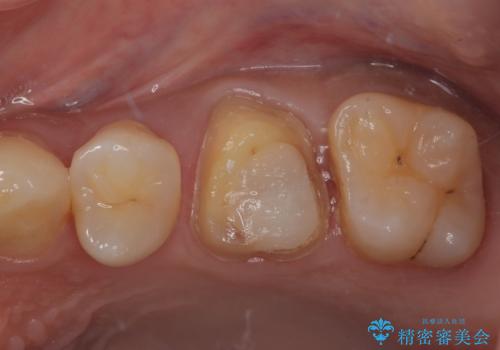 銀歯を外したい オールセラミッククラウンの治療中