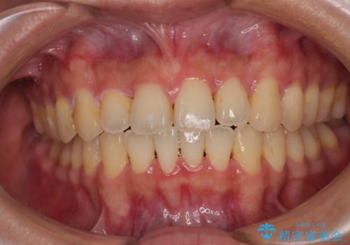 急速拡大装置 狭い歯列を拡大してクロスバイトを短期間矯正治療の症例 治療後