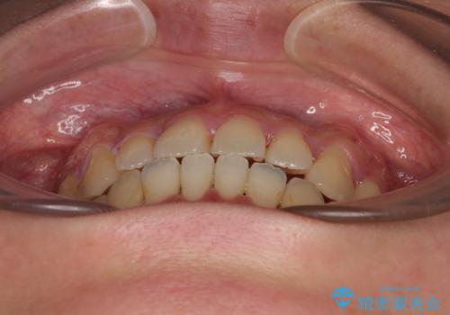 急速拡大装置 狭い歯列を拡大してクロスバイトを短期間矯正治療の治療後