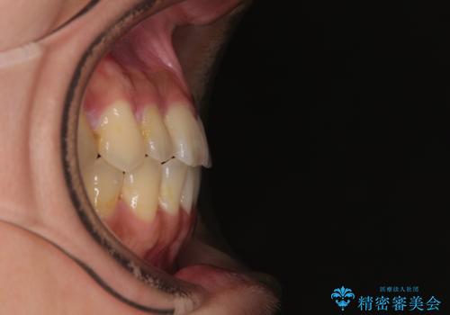 急速拡大装置 狭い歯列を拡大してクロスバイトを短期間矯正治療の治療後