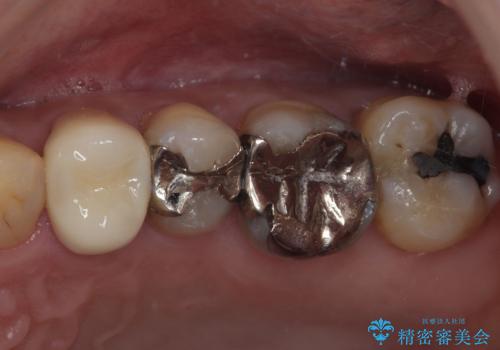 矯正が終わったのでセラミックに変えていきたい オールセラミッククラウンの症例 治療後