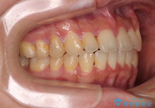 急速拡大装置 狭い歯列を拡大してクロスバイトを短期間矯正治療の治療後