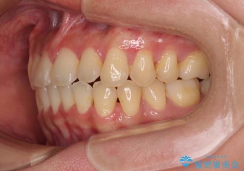 急速拡大装置 狭い歯列を拡大してクロスバイトを短期間矯正治療の治療後