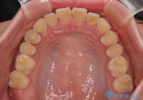 急速拡大装置 狭い歯列を拡大してクロスバイトを短期間矯正治療の治療後