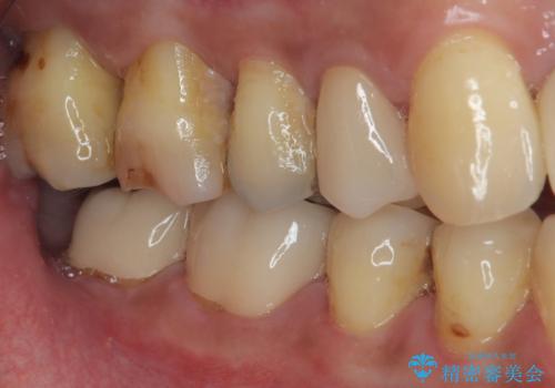 銀歯の下の虫歯を治したい オールセラミッククラウン・セラミックインレー修復の治療後