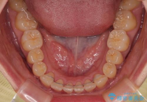 急速拡大装置 狭い歯列を拡大してクロスバイトを短期間矯正治療の治療後
