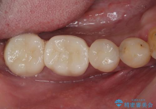 銀歯の下の虫歯を治したい オールセラミッククラウン・セラミックインレー修復の症例 治療後