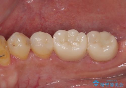 銀歯の下の虫歯を治したい オールセラミッククラウン・セラミックインレー修復の治療後