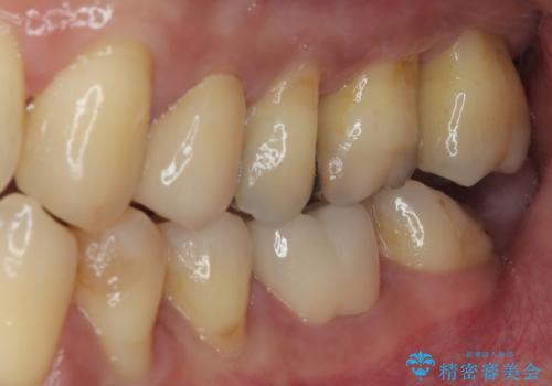 矯正が終わったのでセラミックに変えていきたい オールセラミッククラウンの治療後