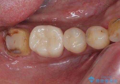 銀歯の下の虫歯を治したい オールセラミッククラウン・セラミックインレー修復の治療中