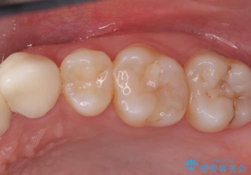 虫歯を治したい〈セラミック〉の治療前