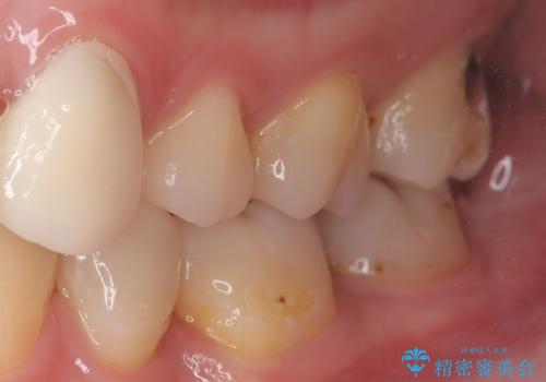 虫歯を治したい〈セラミック〉の症例 治療前