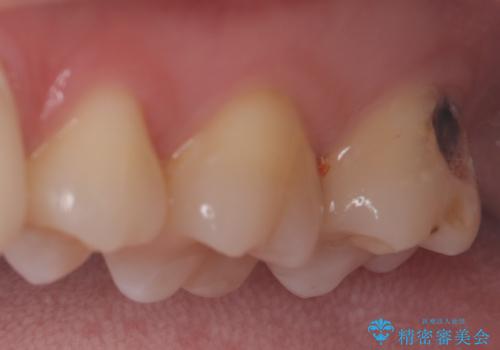 虫歯を治したい〈セラミック〉