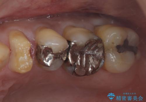 矯正が終わったのでセラミックに変えていきたい オールセラミッククラウンの治療中