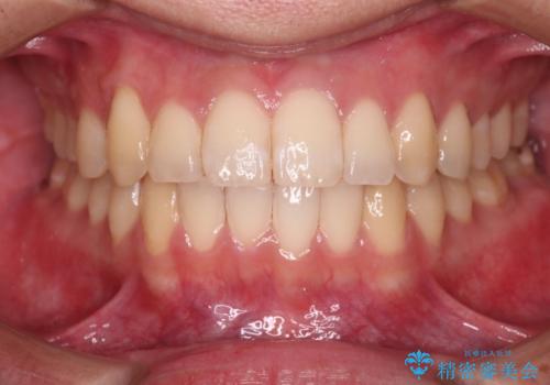 【クリア装置】八重歯とがたつきを綺麗にの症例 治療後