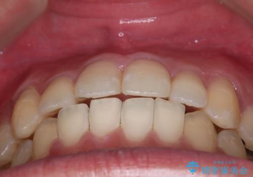 【クリア装置】八重歯とがたつきを綺麗にの治療後