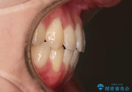 【クリア装置】八重歯とがたつきを綺麗にの治療後