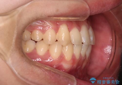 【クリア装置】八重歯とがたつきを綺麗にの治療後