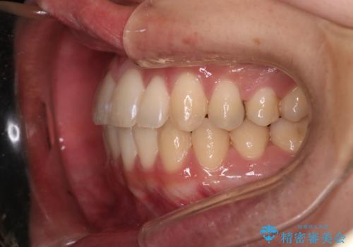 【クリア装置】八重歯とがたつきを綺麗にの治療後