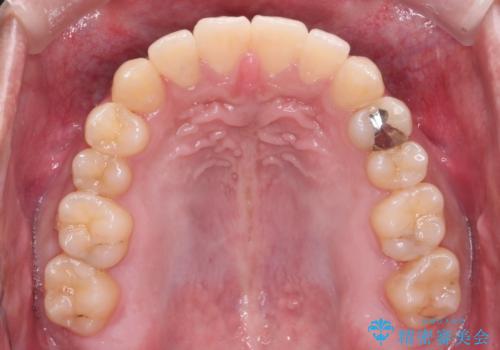 【クリア装置】八重歯とがたつきを綺麗にの治療後