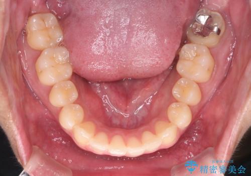 【クリア装置】八重歯とがたつきを綺麗にの治療後