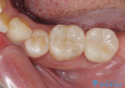 抜歯即時インプラントで治療期間を大幅短縮!抜歯からセラミックまでを3か月で完了の症例 治療後