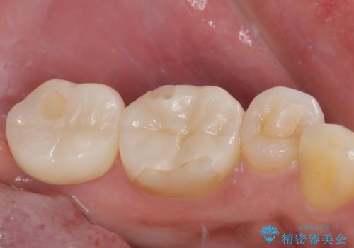 抜歯即時インプラントで治療期間を大幅短縮!抜歯からセラミックまでを3か月で完了の治療後