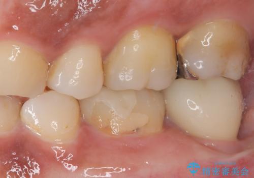 抜歯即時インプラントで治療期間を大幅短縮!抜歯からセラミックまでを3か月で完了の治療後
