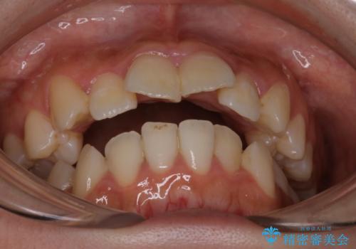 【インビザライン】マウスピースで開咬改善の治療前