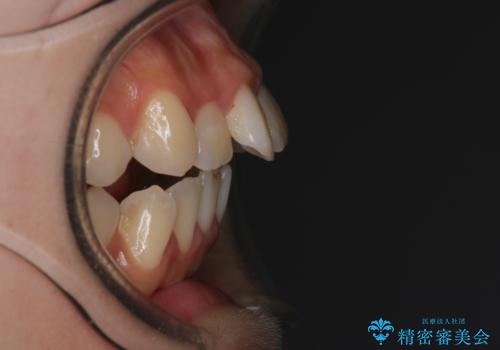 【インビザライン】マウスピースで開咬改善の治療前