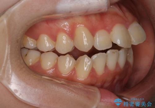 【インビザライン】マウスピースで開咬改善の治療前