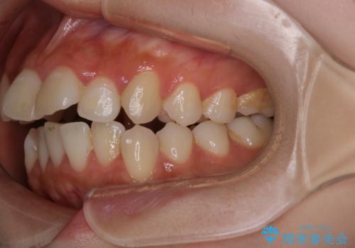 【インビザライン】マウスピースで開咬改善の治療前