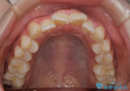 【インビザライン】マウスピースで開咬改善の治療前